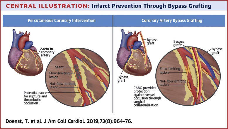 PTCA-BYPASS