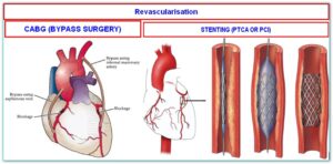 PTCA-BYPASS