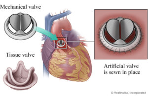 Mechanical vs. Tissue Valve