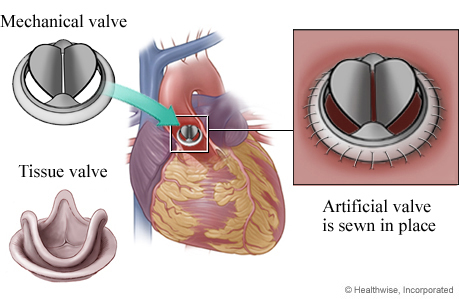 Mechanical vs. Tissue Valve