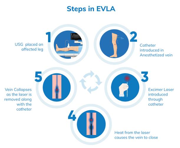 Endovenous laser ablation